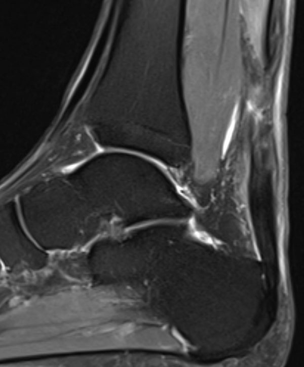 MRT Bild 4 Wochen alte Achillessehenruptur nach der Operation