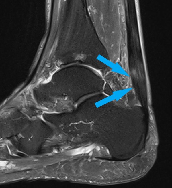 ausgeprägte Achillodynie mit Strukturdefekt in der Achillessehne
