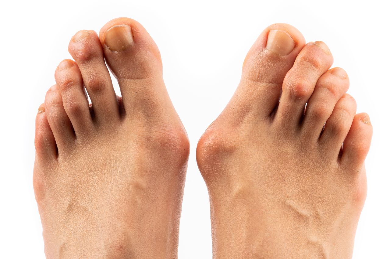 Hallux Valgus Operation in Berlin durch Spezialist Dr. Böhr