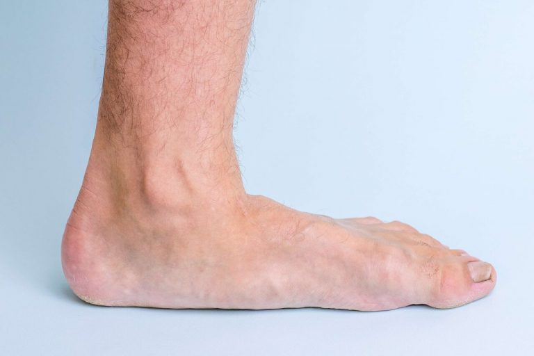 Tibialis Posterior Syndrom ORTHO PEDE Zentrum für Fuß und Sprunggelenk