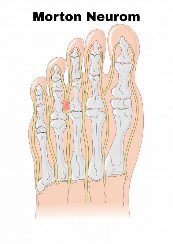 Morton Neurom Anatomie Fußschmerzen