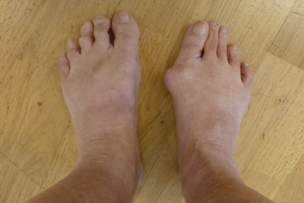 Hallux Valgus linke Seite vor und rechte Seite nach OP