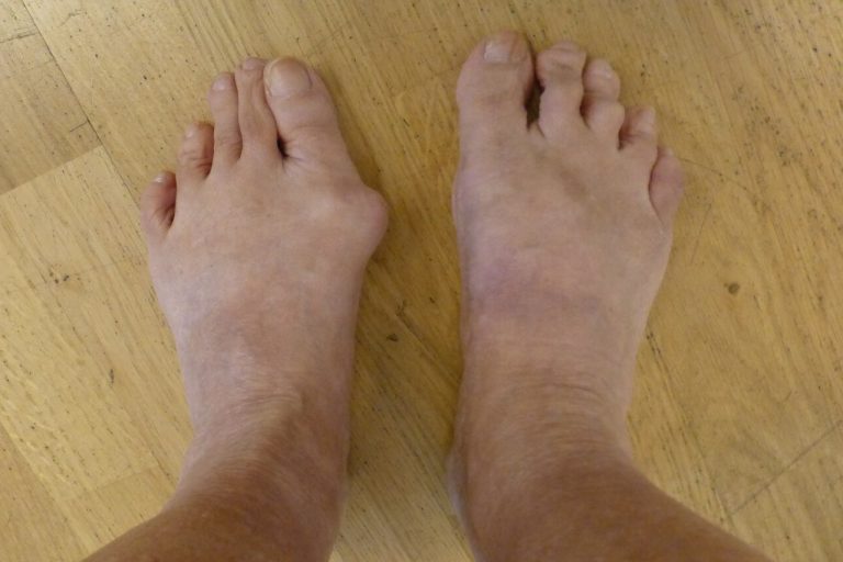 Hallux vor und nach OP gespiegelt ORTHO PEDE Zentrum für Fuß und Sprunggelenk