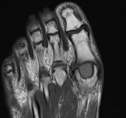 Arthrose Großzehe Cartiva Implantat MRT Bild T1 TSE