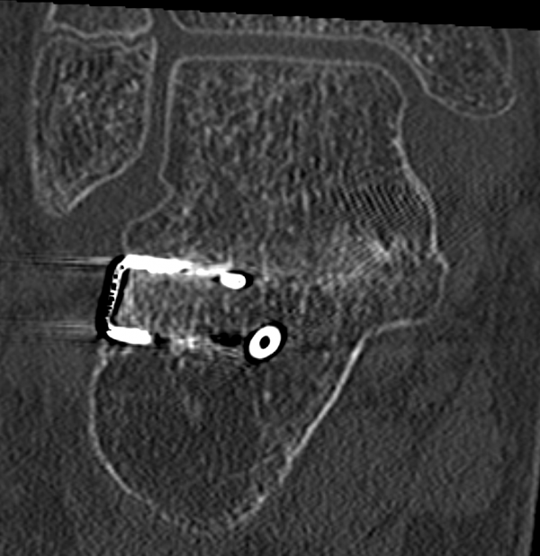 Coalitio talo-calcaneare nach Korrektur-Osteotomie und Arthrodese | ORTHO | PEDE Zentrum für Fuß und Sprunggelenk Coalitio talo-calcaneare nach Korrektur-Osteotomie und Arthrodese