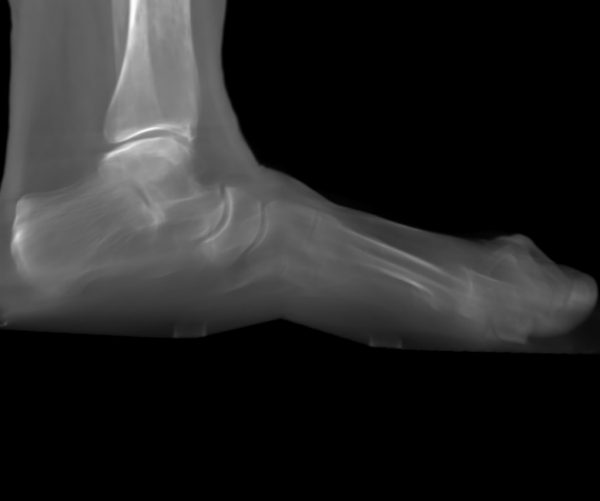 DVT Rheumatoide Arthritis mit USG Arthrose & Fehlstellung