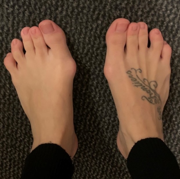 Hallux Valgus beide Füße gleichzeitig operieren? ORTHO PEDE Zentrum für Fuß und Sprunggelenk