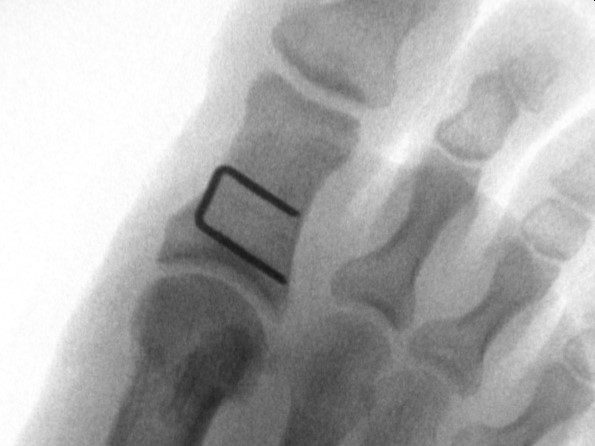 Hallux Valgus Korrektur Akin Chevron | ORTHO | PEDE Zentrum für Fuß und Sprunggelenk Hallux Valgus Korrektur Akin & Chevron