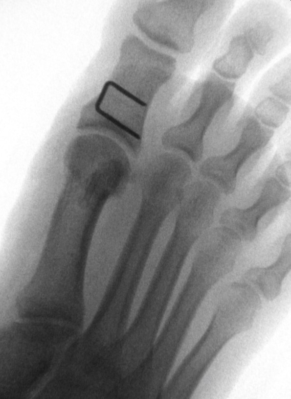 Hallux Valgus Operation in Berlin durch Spezialist Dr. Böhr