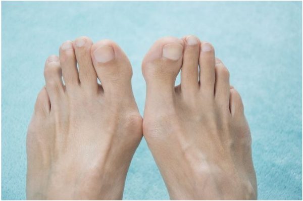 schwerer Hallux Valgus beider Füße