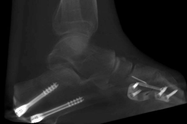 complex flat foot surgery case by Dr. Stefan Böhr