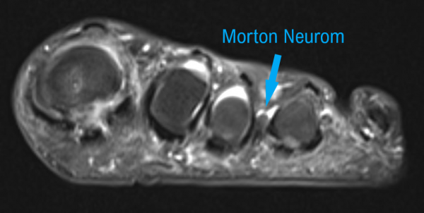 MRT Morton Neurom 6mm