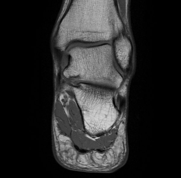 MRT OSG cor T1 gesund