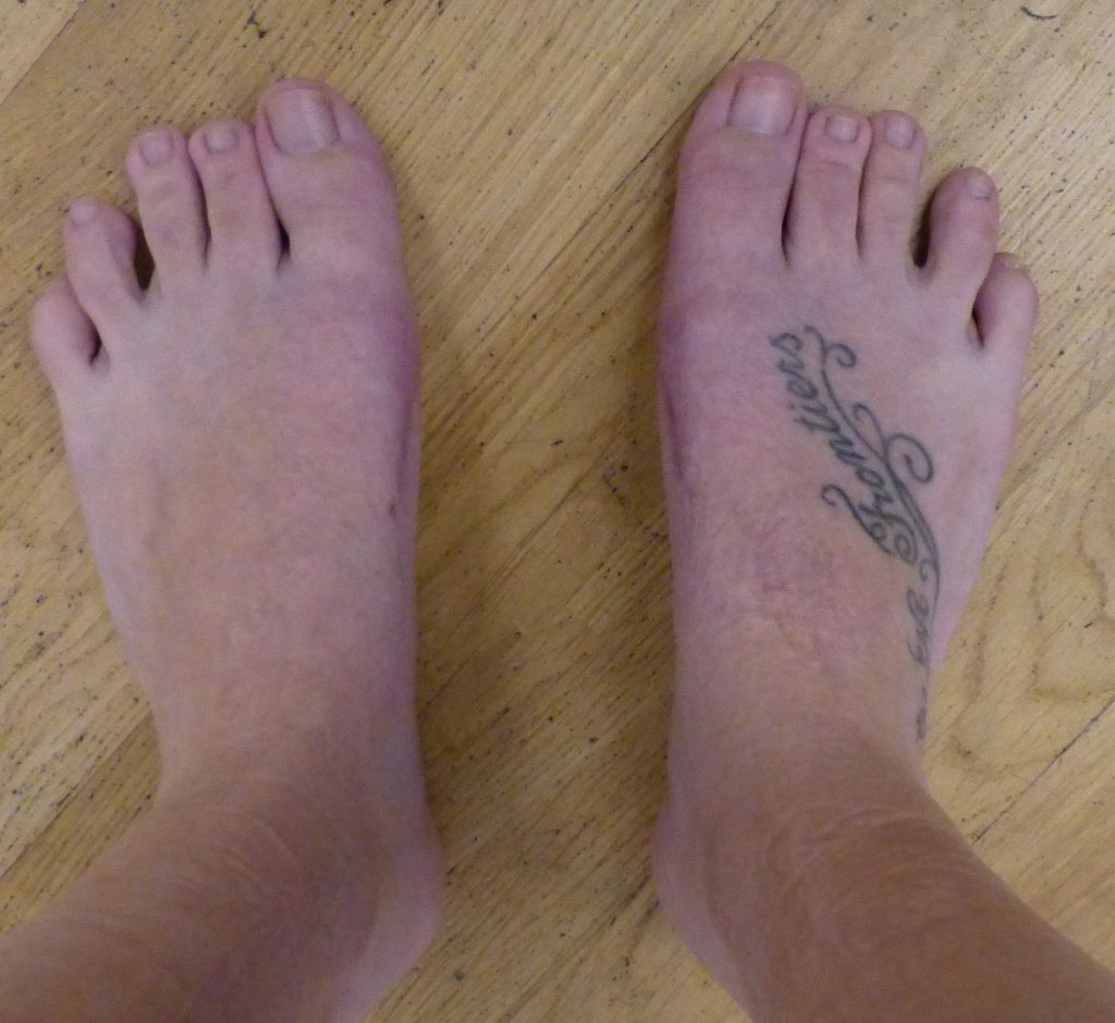 Hallux Valgus beidseitig in einem Eingriff operiert 8 Wochen nach der OP | ORTHO | PEDE Zentrum für Fuß und Sprunggelenk Hallux Valgus beidseitig in einem Eingriff operiert 8 Wochen nach der OP