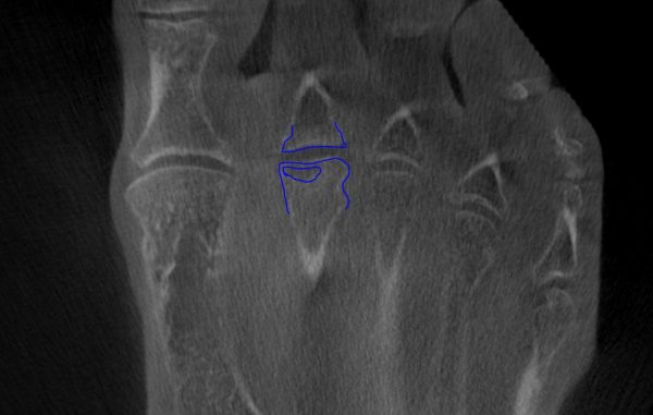 Morbus Koehler 2 DVT tranversal mit blau gezeichnetem Köpfchen