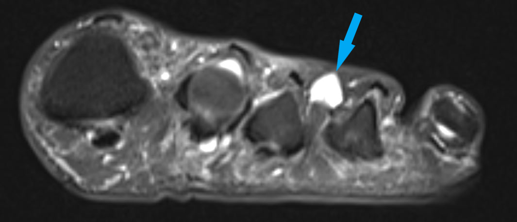Morton Neurom | ORTHO | PEDE Zentrum für Fuß und Sprunggelenk