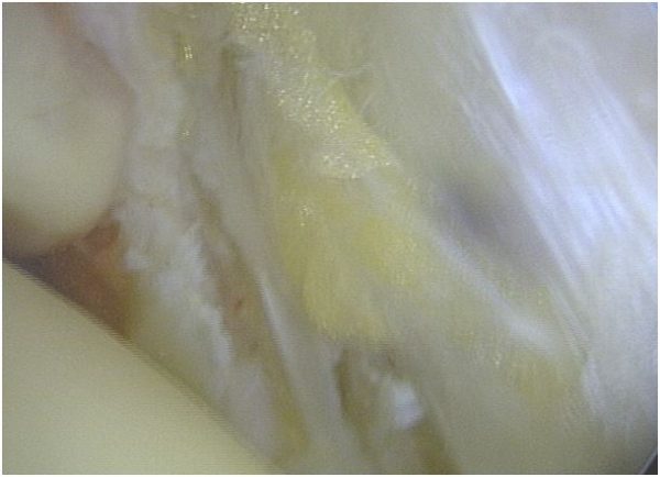 OSG ASKP Basset Ligament Resektion