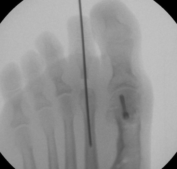 Röntgebild aus dem OP von Dr. Böhr in der Klinik Sanssouci: Stainsby OP am zweiten Zeh bei kontrakter Krallenzehe und Hallux Valgus
