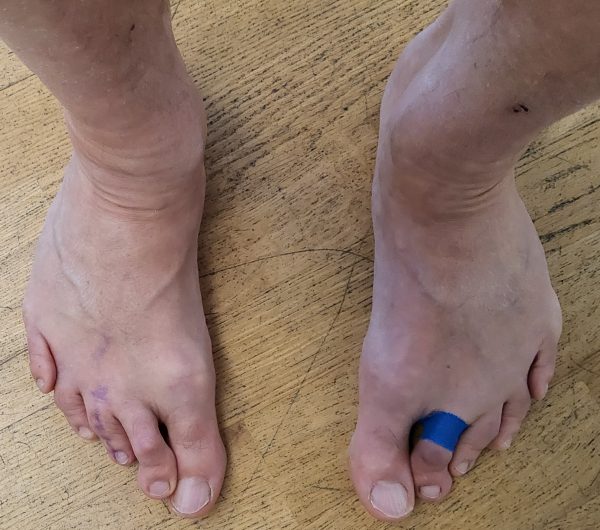 Sichelfuß bds Fersentyp