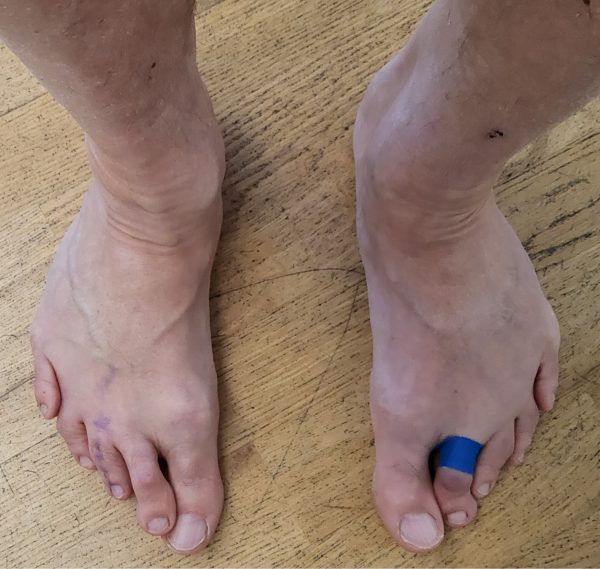 Sichelfuß bds Zehentyp