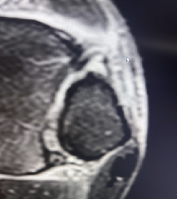 Syndesmose Verletzung  MRT