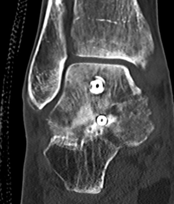 lUSG Arthrodese 8 Wochen post OP frontalebene Spaninterposition zur Achskorrektur lateral CT