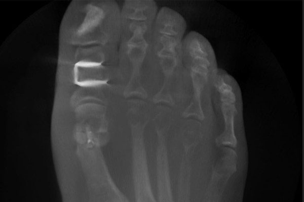 Hallux Valgus OP Berlin Youngswick und Akin | ORTHO | PEDE Zentrum für Fuß und Sprunggelenk Hallux Valgus OP Berlin Youngswick und Akin