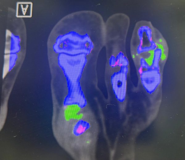 dual energy CT bei Gicht am Fuß | ORTHO | PEDE Zentrum für Fuß und Sprunggelenk dual energy CT bei Gicht am Fuß