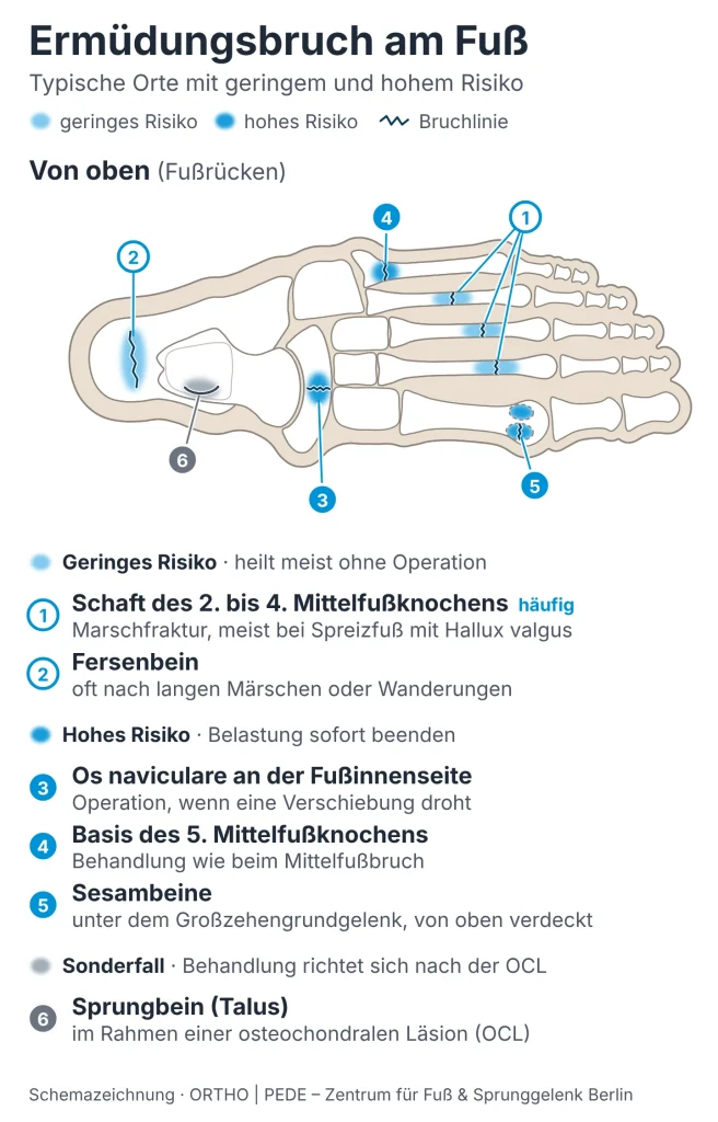 Ermüdungsbruch am Fuß: typische Orte mit geringem und hohem Risiko | ORTHO | PEDE Zentrum für Fuß und Sprunggelenk Schemazeichnung Fußskelett von oben: typische Orte eines Ermüdungsbruchs am Fuß, mit geringem Risiko am Schaft des 2. bis 4. Mittelfußknochens und am Fersenbein, mit hohem Risiko am Os naviculare, an der Basis des 5. Mittelfußknochens und an den Sesambeinen, dazu das Sprungbein im Rahmen einer OCL