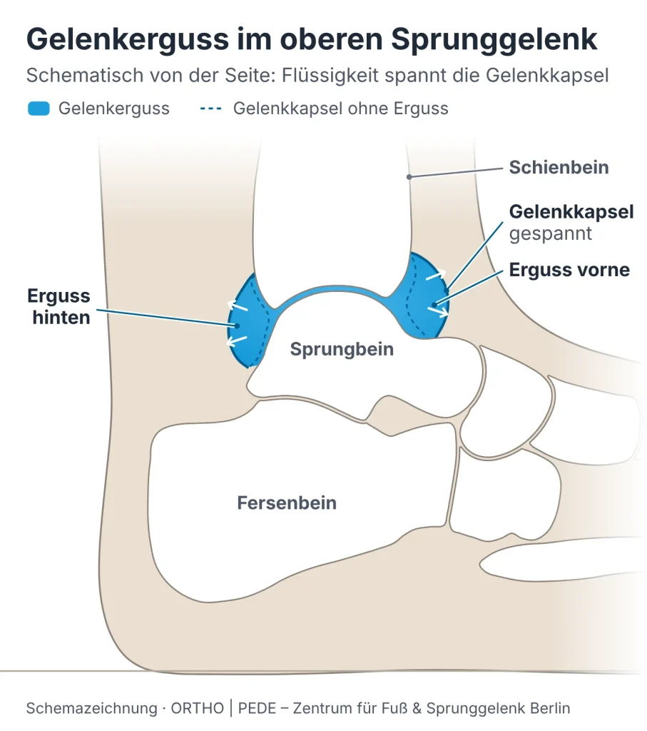 gelenkerguss-sprunggelenk-schema | ORTHO | PEDE Zentrum für Fuß und Sprunggelenk Schemazeichnung des oberen Sprunggelenks von der Seite: Ein Gelenkerguss füllt die vordere und hintere Ausbuchtung der Gelenkkapsel zwischen Schienbein und Sprungbein und spannt die Kapsel.