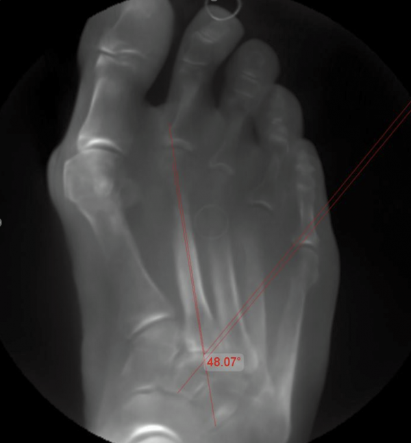 Sichelfuß mit eingezeichnetem Engelwinkel