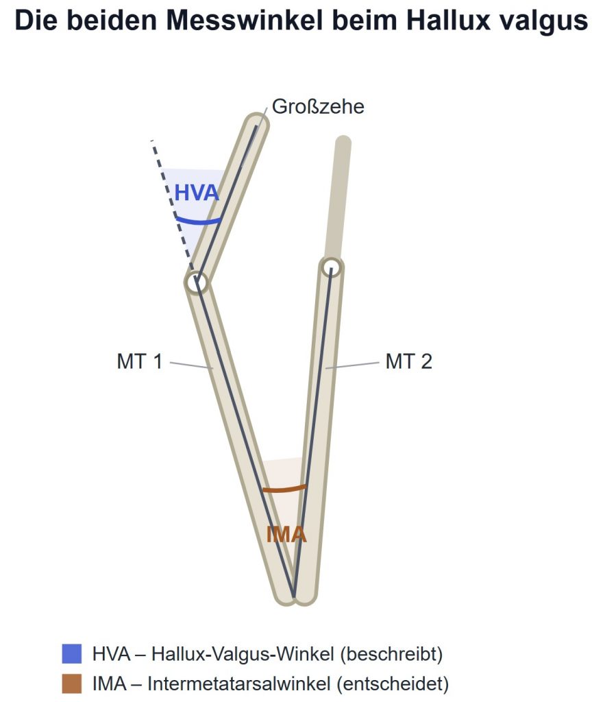 Illustration of two angles used to assess Hallux valgus: HVA (blue) between the first metatarsal and big toe, and IMA (brown) between the first and second metatarsals, with MT1/MT2 labels.