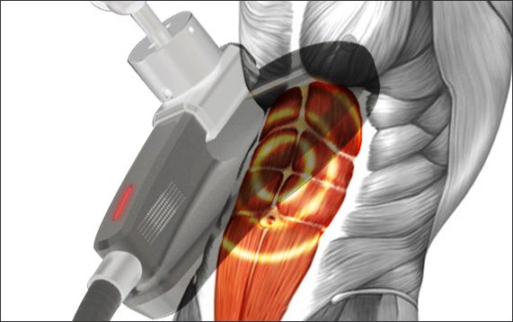  Pulsed Electromagnetic Field Therapy (PEMF) Anwendung bei Rückenschmerzen