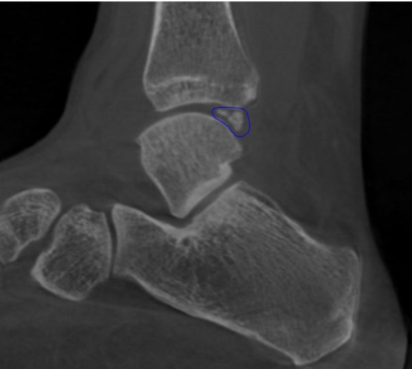 Impingement OSG dorsal sagital