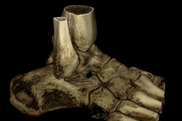Inkokmplette Coalitio talo-calcaneare 3D Bild DVT