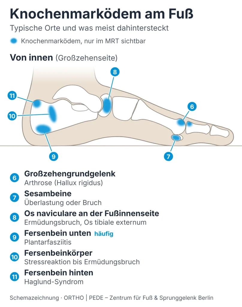 knochenmarkoedem-fuss-von-innen-schema | ORTHO | PEDE Zentrum für Fuß und Sprunggelenk Schemazeichnung Fußskelett von innen: typische Orte eines Knochenmarködems in Fersenbein, Os naviculare, Großzehengrundgelenk und Sesambeinen