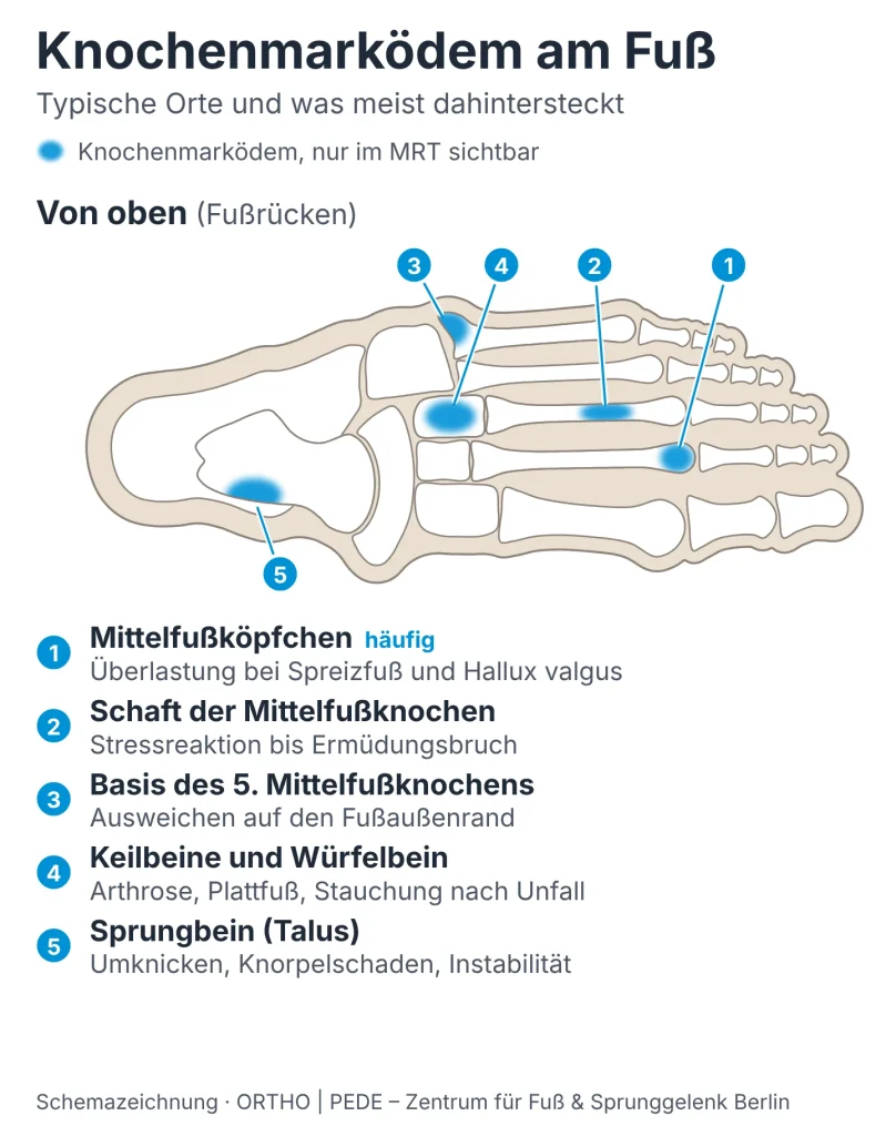 knochenmarkoedem-fuss-von-oben-schema | ORTHO | PEDE Zentrum für Fuß und Sprunggelenk Schemazeichnung Fußskelett von oben: typische Orte eines Knochenmarködems in Mittelfuß, Fußwurzel und Sprungbein