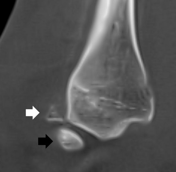 Kombination aus frischer Verletzung der distlen Fibula und os subfibulare | ORTHO | PEDE Zentrum für Fuß und Sprunggelenk Kombination aus frischer Verletzung der distlen Fibula und os subfibulare