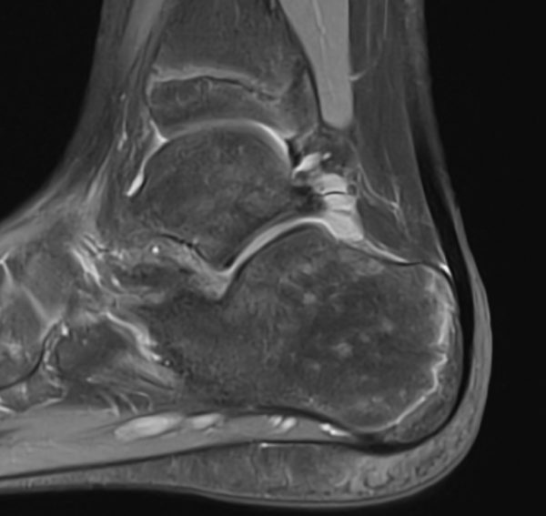 Morbus Sever und Knochenmildendes Mark im Fersenbeinnochenmarksignal im Fersenbein bei Haematopoese PD TSE SAG FS | ORTHO | PEDE Zentrum für Fuß und Sprunggelenk Morbus Sever und Knochenmildendes Mark im Fersenbein