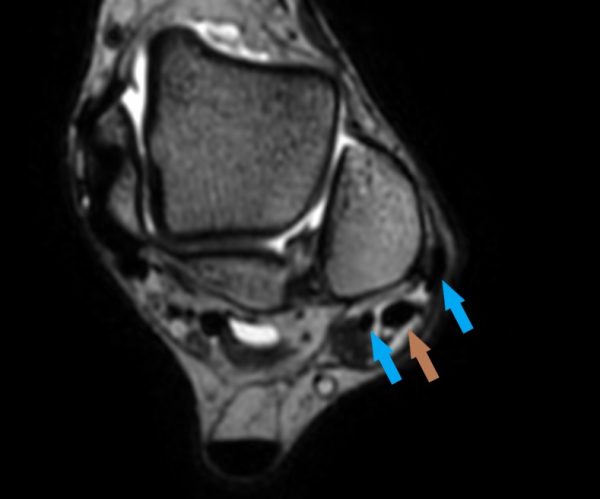 Chronische Peronealsehnenluxation mit Tendon split der Peroneus brevis Sehne