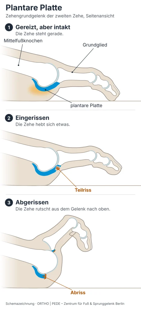 plantare-platte-drei-situationen-schema | ORTHO | PEDE Zentrum für Fuß und Sprunggelenk Schemazeichnung der plantaren Platte am Zehengrundgelenk von der Seite: gereizt, aber intakt – eingerissen – abgerissen mit nach oben luxierter Zehe