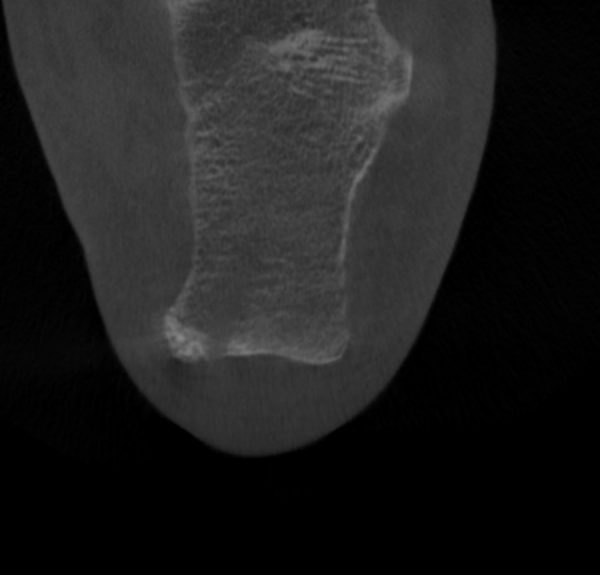 Haglund Syndrom und hinterer Fersensporn post OP