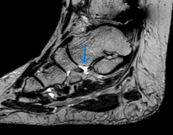 posttraumatische Läsion Pfannenband Ligamentum talo-naviculare plantare | ORTHO | PEDE Zentrum für Fuß und Sprunggelenk posttraumatische Läsion Pfannenband Ligamentum talo-naviculare plantare