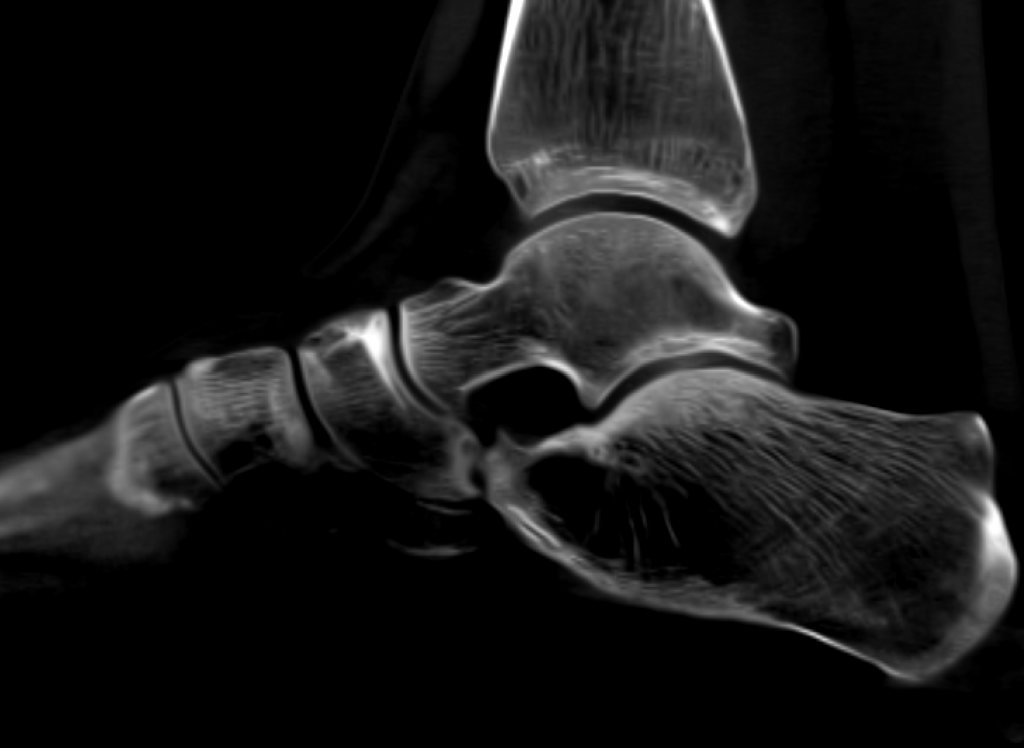 schmerzhafte inkomplette Coalitio-Calcaneo-navioculare vor Operation | ORTHO | PEDE Zentrum für Fuß und Sprunggelenk Schmerzhafte inkomplette Coalitio-Calcaneo-naviculare vor Operation