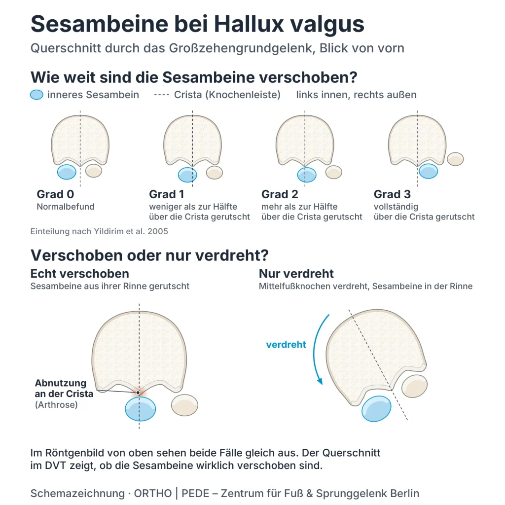 sesambeine-hallux-valgus-schema-1 | ORTHO | PEDE Zentrum für Fuß und Sprunggelenk Schema: Sesambeine bei Hallux valgus im Querschnitt – Verschiebung Grad 0 bis 3, echt verschoben oder nur verdreht