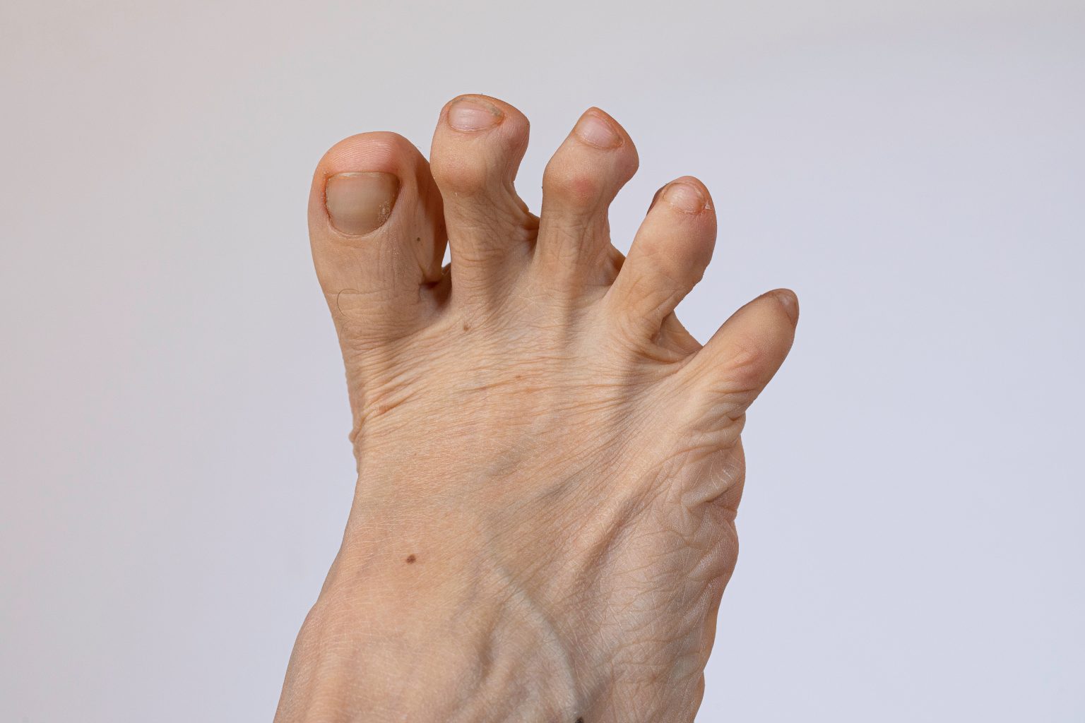 Hammerzehe und Krallenzehe was kann man tun? Minimalinvasive Therapie im Zentrum für Fuß
