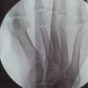 Sichelfuß & Hallux Valgus Korrektur mit TMT 1 Arthrodese und DMMO 2-4 vor Korrektur