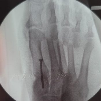 Sichelfuß & Hallux Valgus Korrektur mit TMT 1 Arthrodese und DMMO 2-4