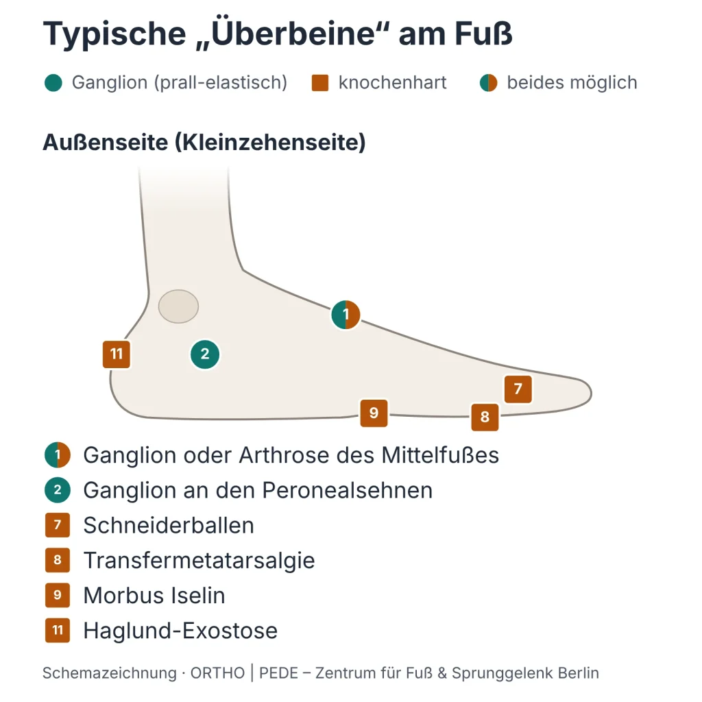 ueberbein-fuss-aussenseite-schema | ORTHO | PEDE Zentrum für Fuß und Sprunggelenk Schemazeichnung: typische Überbeine an der Fußaußenseite – Ganglion, Schneiderballen, Transfermetatarsalgie, Morbus Iselin, Haglund-Exostose
