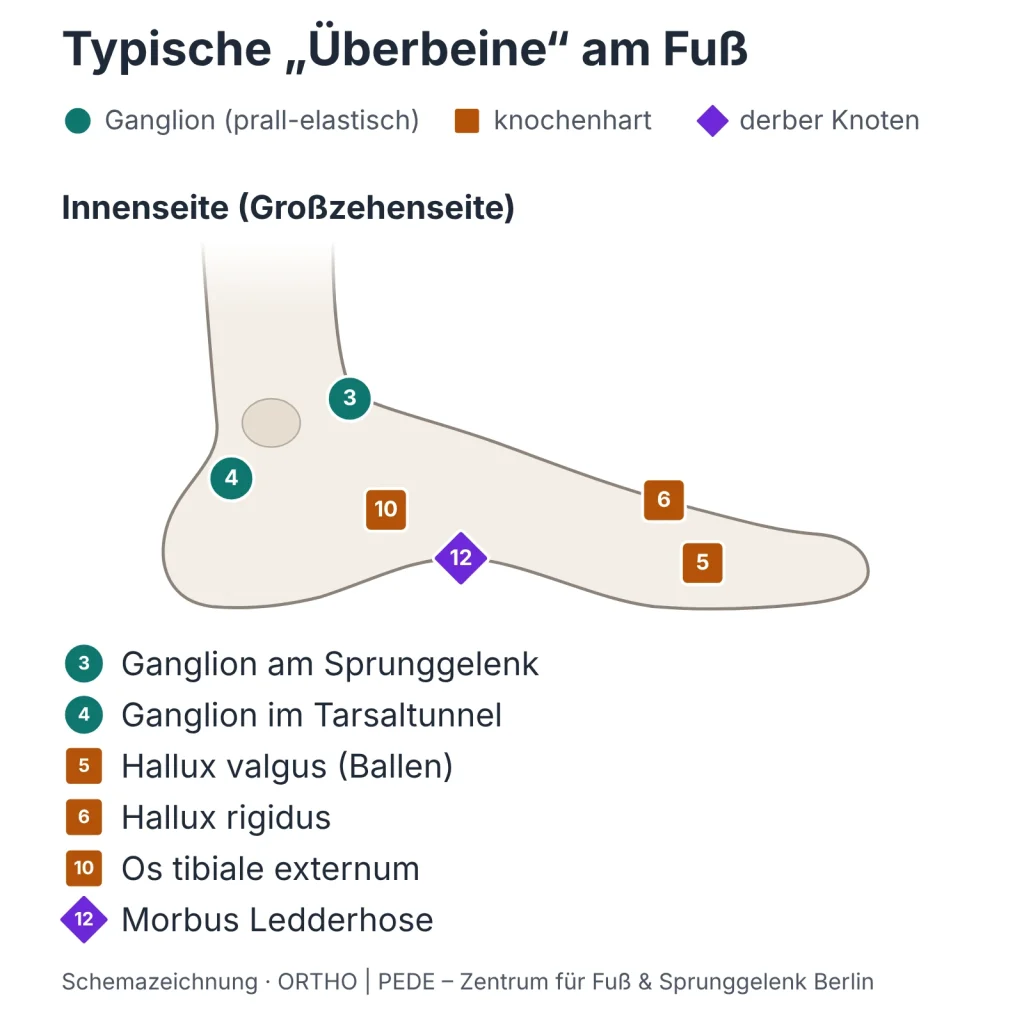 ueberbein-fuss-innenseite-schema | ORTHO | PEDE Zentrum für Fuß und Sprunggelenk Schemazeichnung: typische Überbeine an der Fußinnenseite – Ganglion, Hallux valgus, Hallux rigidus, Os tibiale externum, Morbus Ledderhose